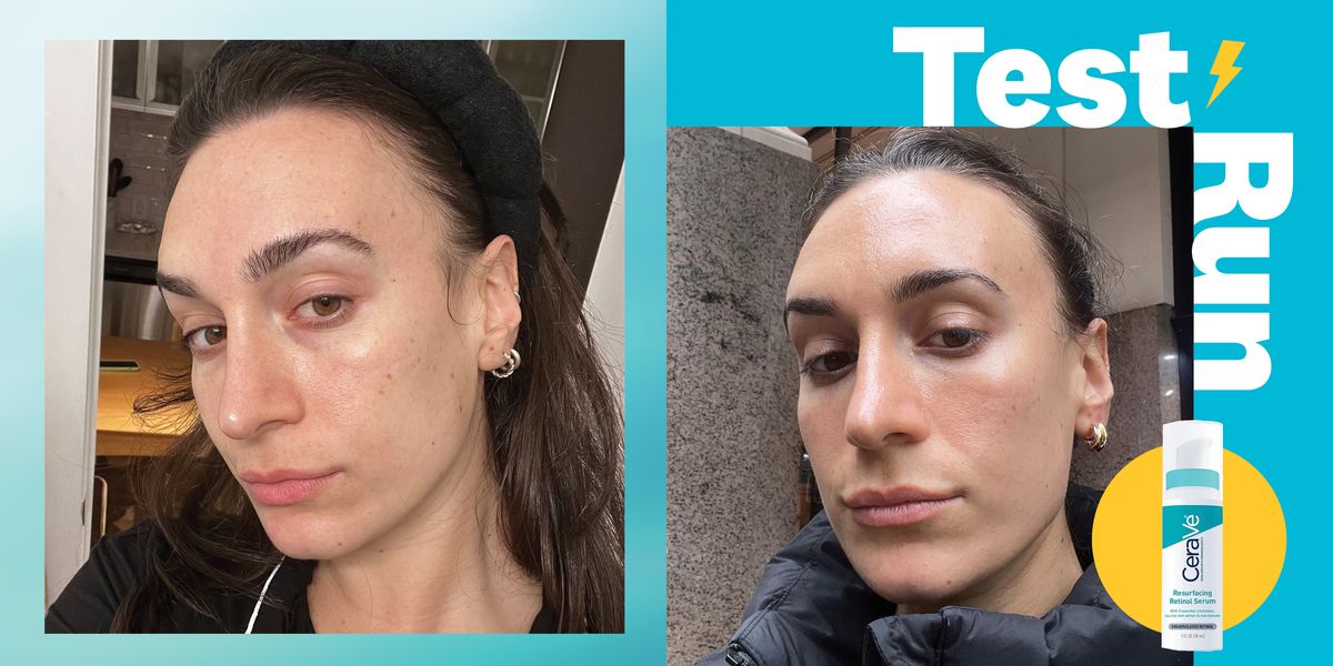 Meine Haut hat eine komplette Veränderung durchgemacht in diesen VorherNachher Retinol Fotos